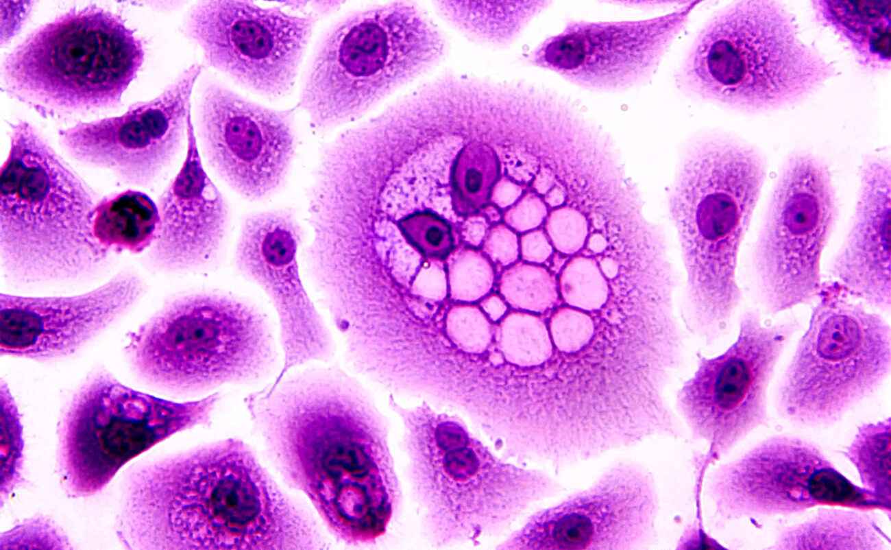 A child with metastatic liver cancer that had stopped responding to chemotherapy is now in remission after doctors treated him with genetically engineered immune cells. Twelve months later, he still appears to be cancer free, offering new hope for treating solid tumors with CAR T therapy.