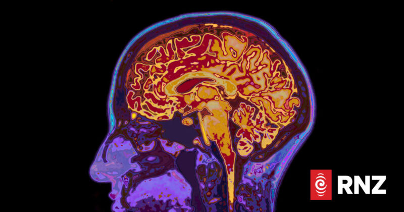 Study Finds Alzheimer’s Disease Increasingly Seen as Treatable Condition